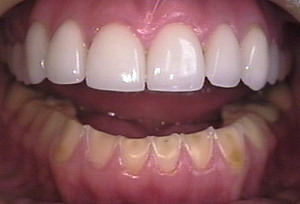 Dental Veneers Fuquay NC